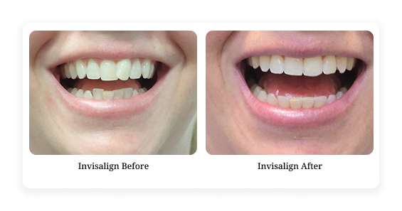 Before & After1